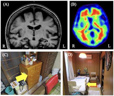 Case Report: Treatment of Delusions of Theft Based on the Assessment of Photos of Patients' Homes